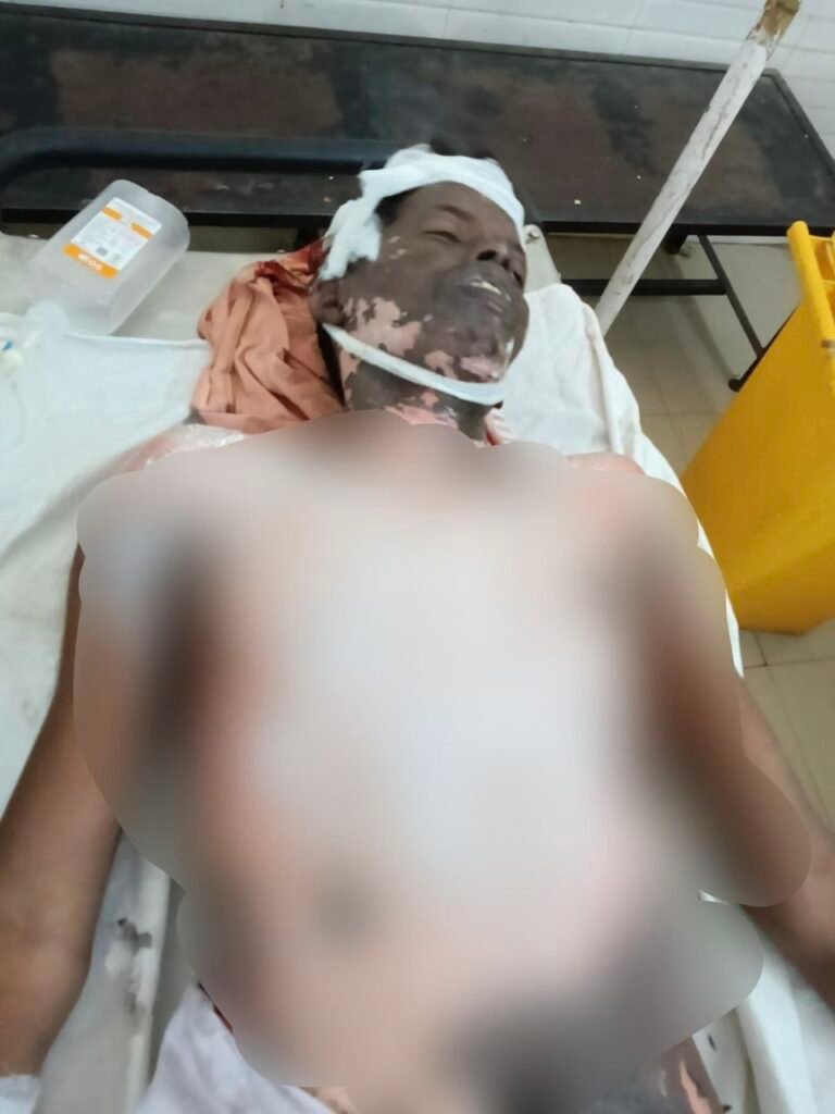 सोनभद्र के युवक के साथ दर्दनाक हादसा: ट्रेन पर कोयला लोड करते समय 11 हजार KV करंट की चपेट में आया श्रमिक